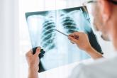 A respirologist examines a lung x-ray