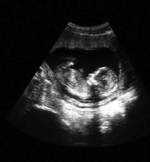 an ultrasound image of a fetus